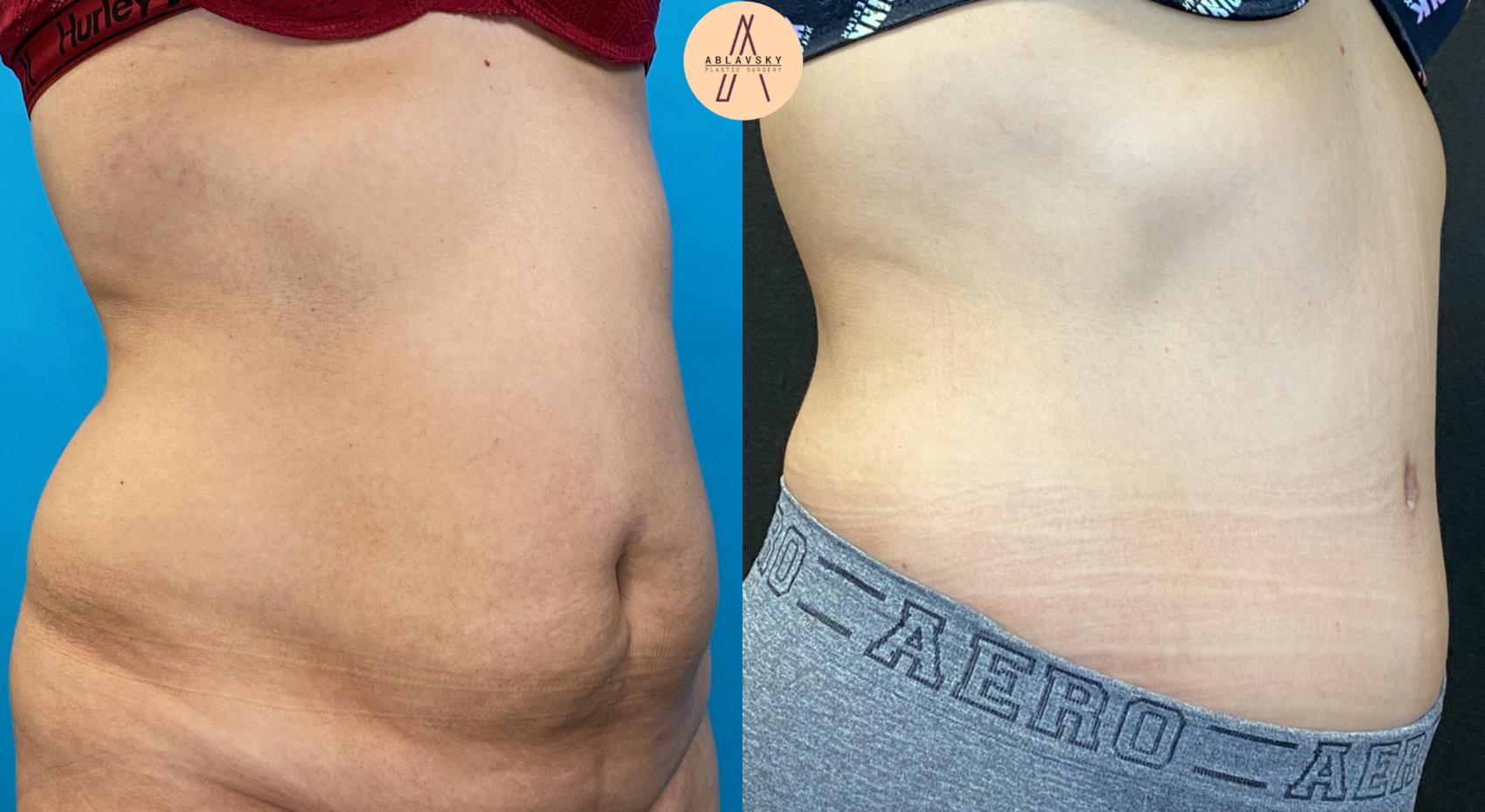 Before & After Tummy Tuck Case 32 Right Oblique View in San Antonio, Texas