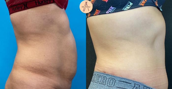 Before & After Tummy Tuck Case 32 Right Side View in San Antonio, Texas