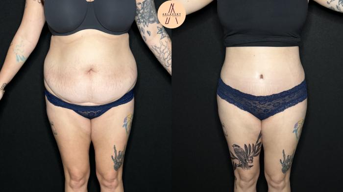 Before & After Tummy Tuck Case 323 Front View in San Antonio, Texas