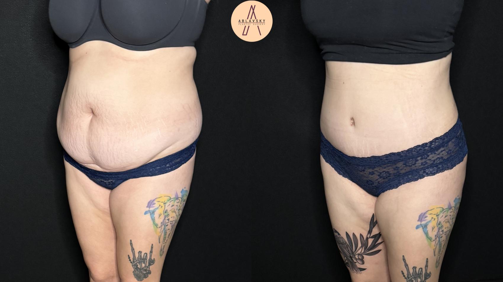 Before & After Liposuction Case 323 Left Oblique View in San Antonio, Texas