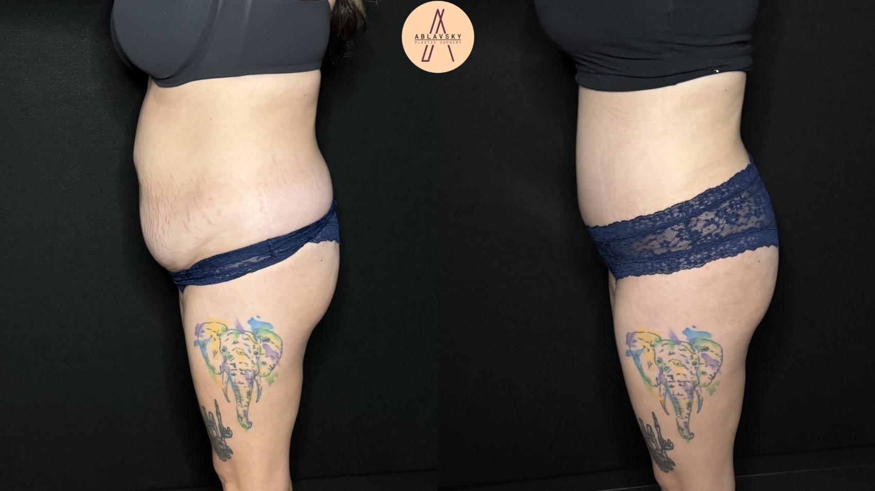 Before & After Liposuction Case 323 Left Side View in San Antonio, Texas