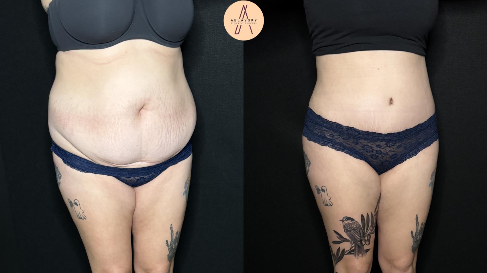 Before & After Liposuction Case 323 Right Oblique View in San Antonio, Texas
