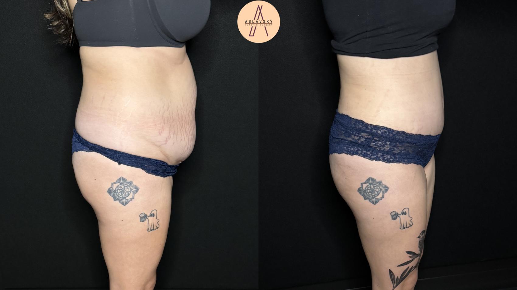 Before & After Liposuction Case 323 Right Side View in San Antonio, Texas