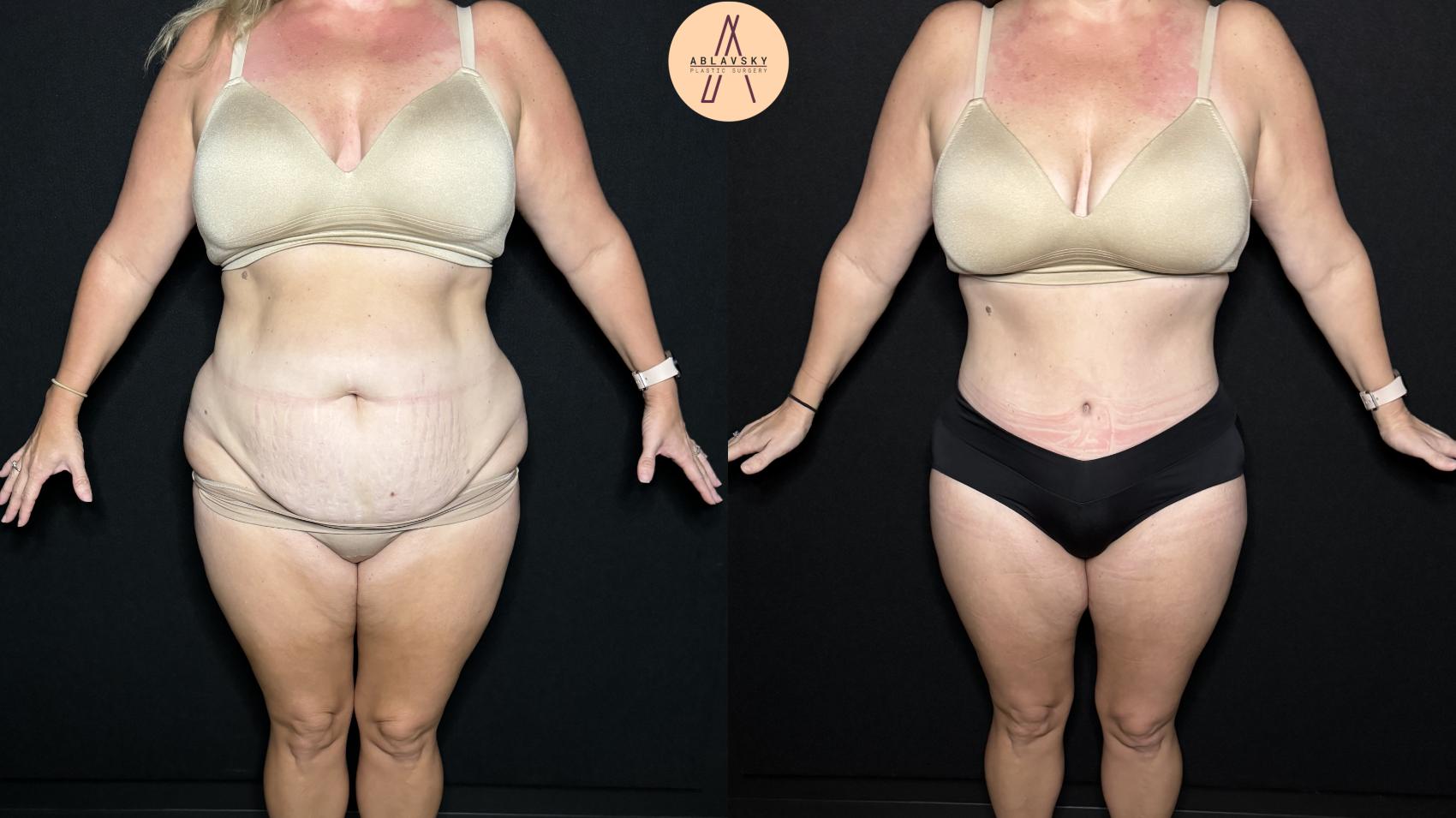 Before & After Liposuction Case 324 Front View in San Antonio, Texas