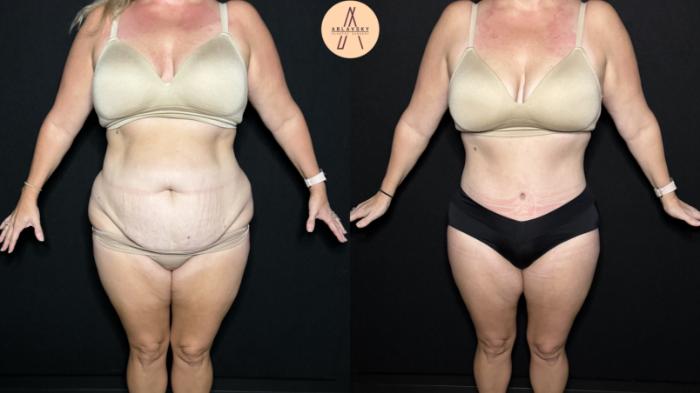 Before & After Tummy Tuck Case 324 Front View in San Antonio, Texas