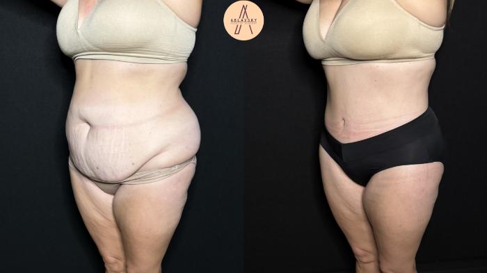 Before & After Liposuction Case 324 Left Oblique View in San Antonio, Texas