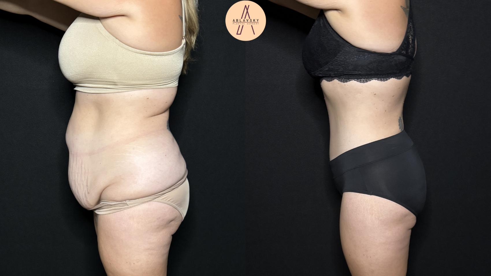 Before & After Tummy Tuck Case 324 Left Side View in San Antonio, Texas