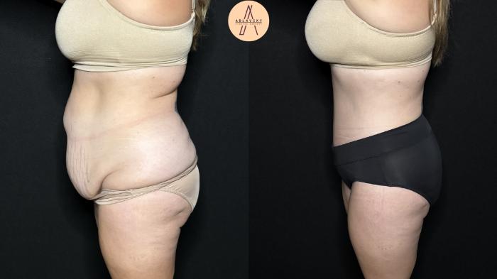 Before & After Tummy Tuck Case 324 Left Side View in San Antonio, Texas