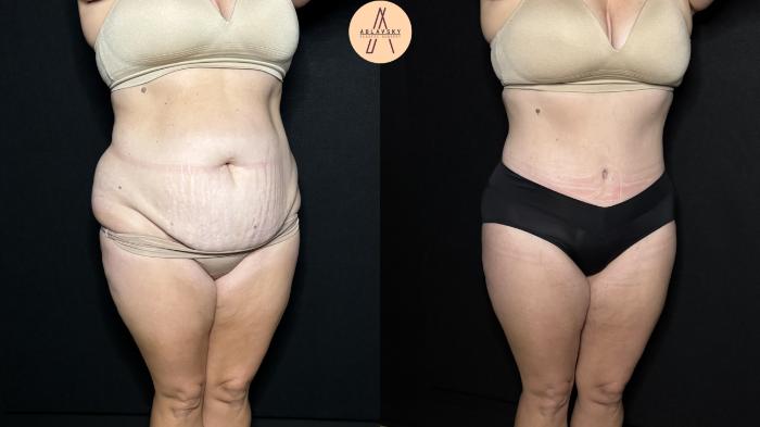 Before & After Liposuction Case 324 Right Oblique View in San Antonio, Texas