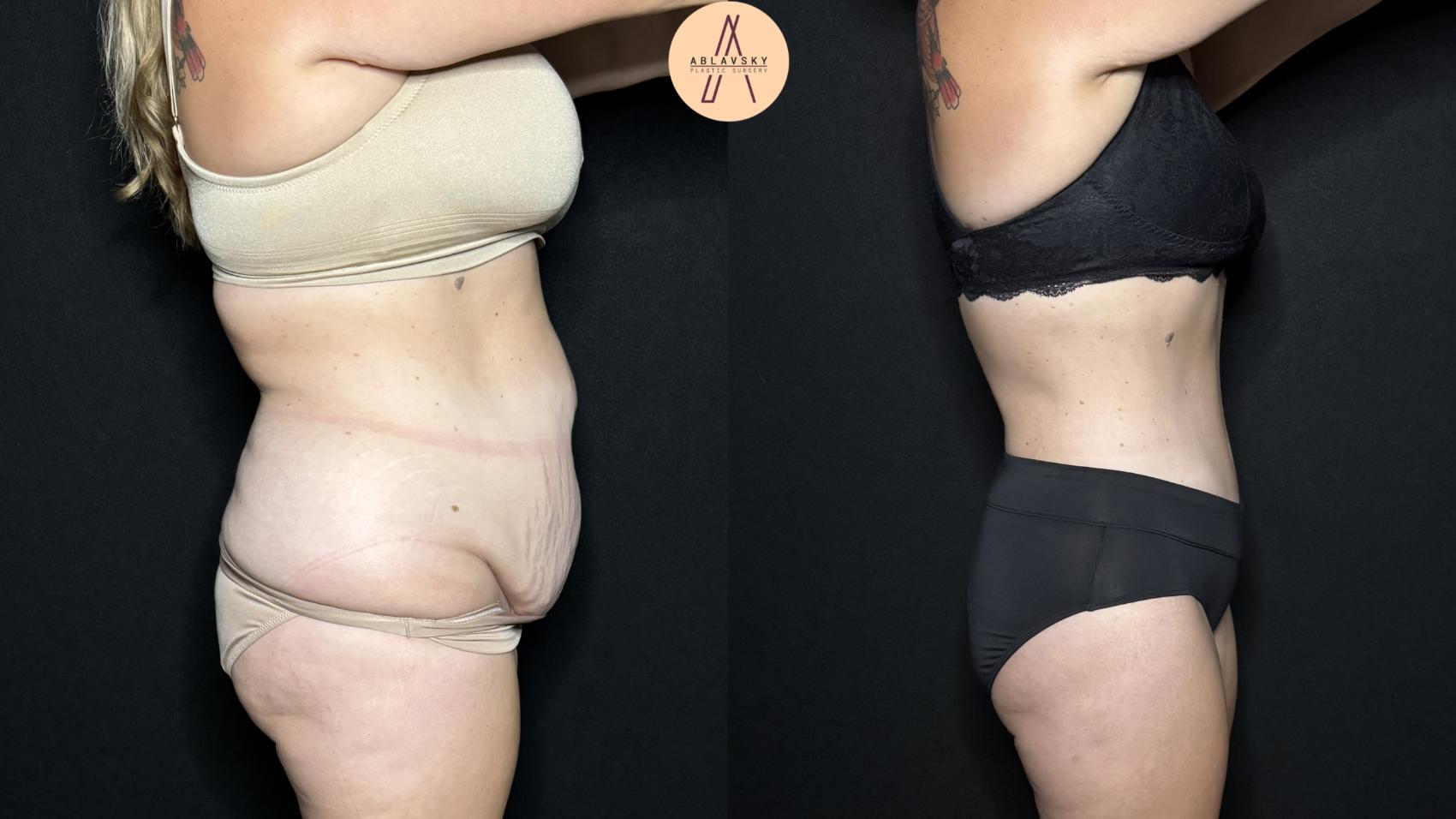 Before & After Tummy Tuck Case 324 Right Side View in San Antonio, Texas