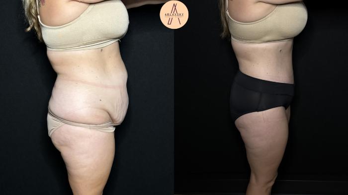 Before & After Liposuction Case 324 Right Side View in San Antonio, Texas