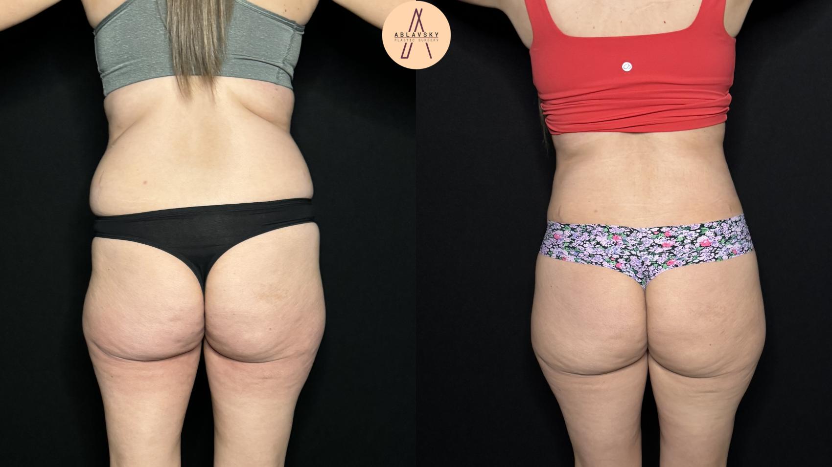 Before & After Tummy Tuck Case 327 Back View in San Antonio, Texas