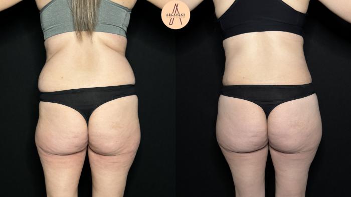 Before & After Tummy Tuck Case 327 Back View in San Antonio, Texas