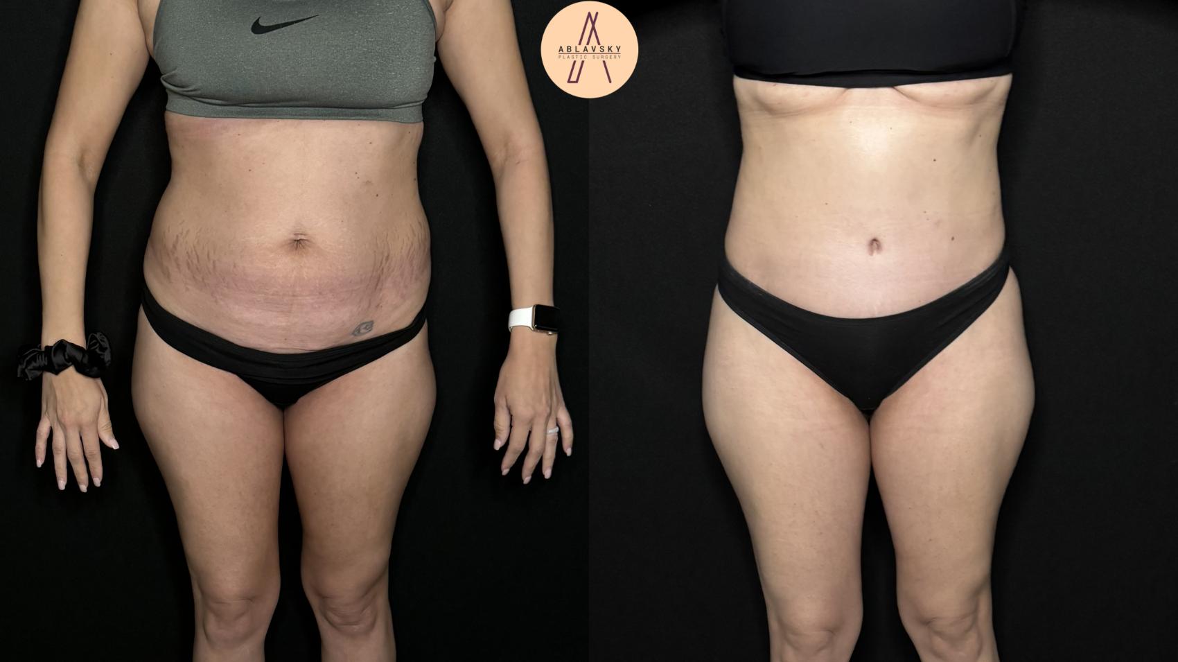 Before & After Tummy Tuck Case 327 Front View in San Antonio, Texas