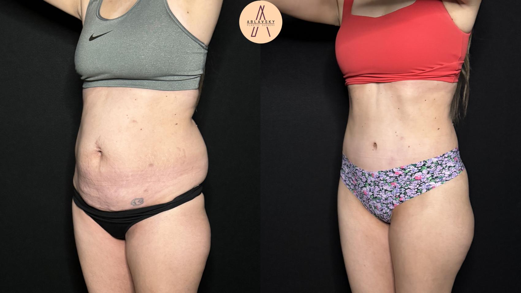 Before & After Tummy Tuck Case 327 Left Oblique View in San Antonio, Texas