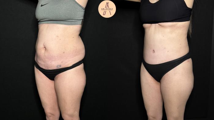 Before & After Tummy Tuck Case 327 Left Oblique View in San Antonio, Texas