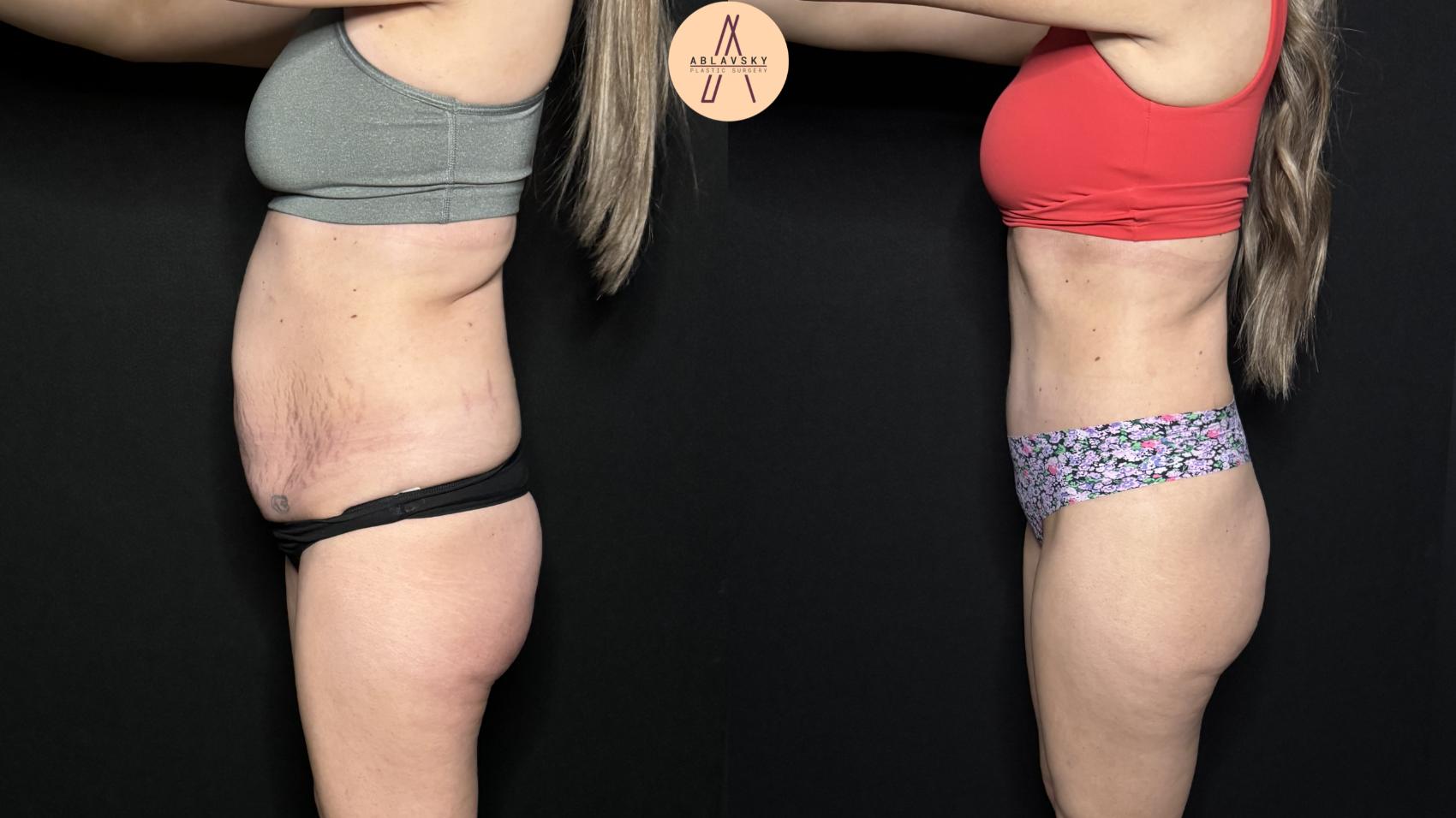 Before & After Tummy Tuck Case 327 Left Side View in San Antonio, Texas