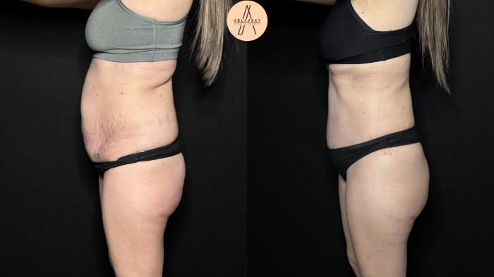 Before & After Tummy Tuck Case 327 Left Side View in San Antonio, Texas