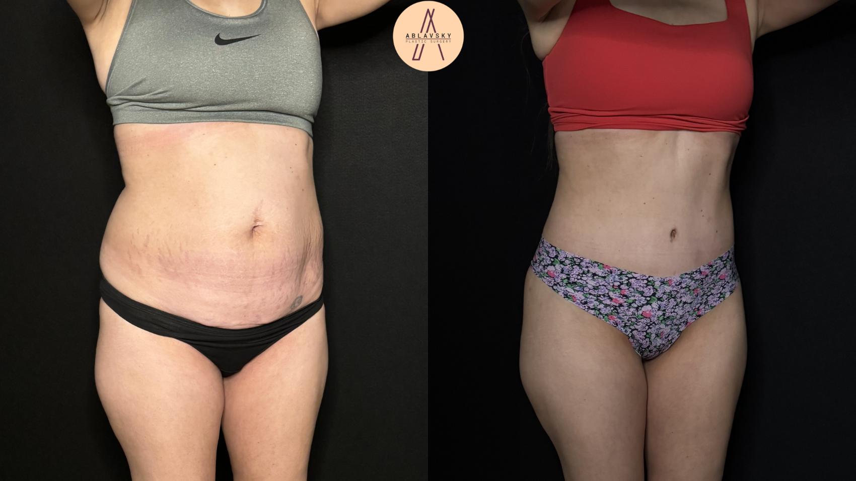 Before & After Tummy Tuck Case 327 Right Oblique View in San Antonio, Texas