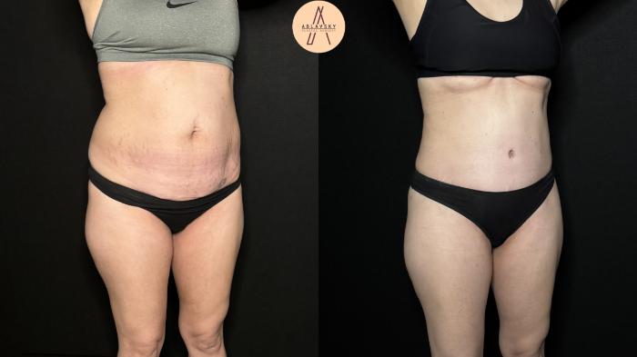 Before & After Tummy Tuck Case 327 Right Oblique View in San Antonio, Texas