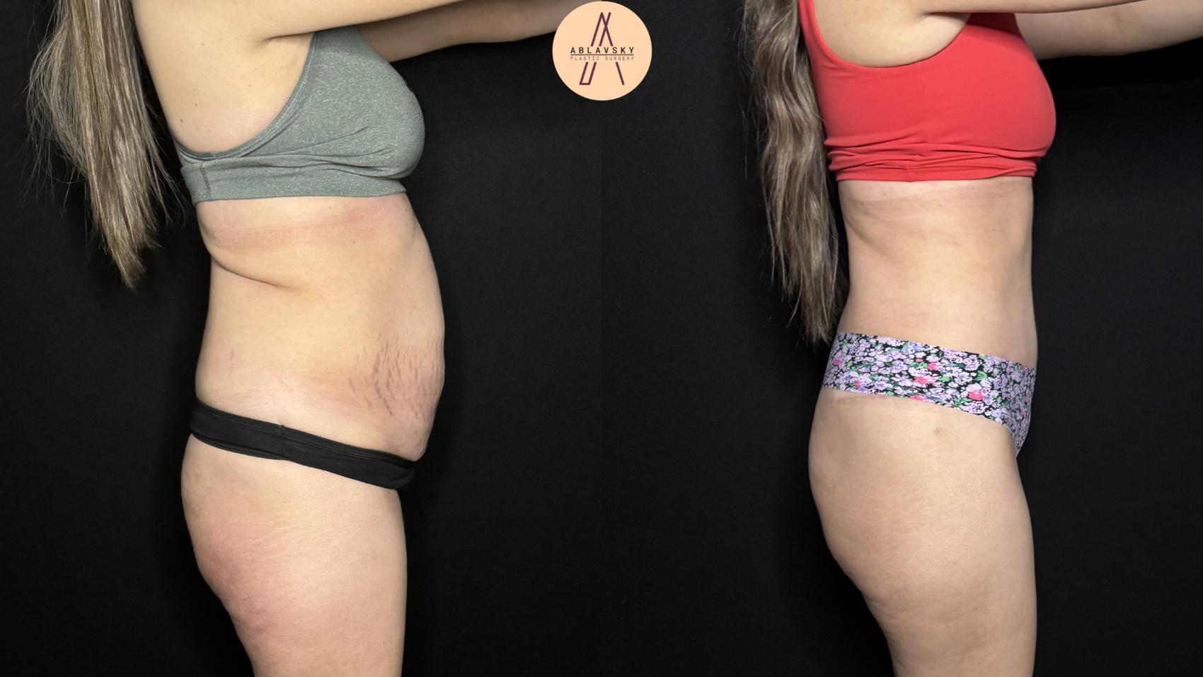 Before & After Tummy Tuck Case 327 Right Side View in San Antonio, Texas