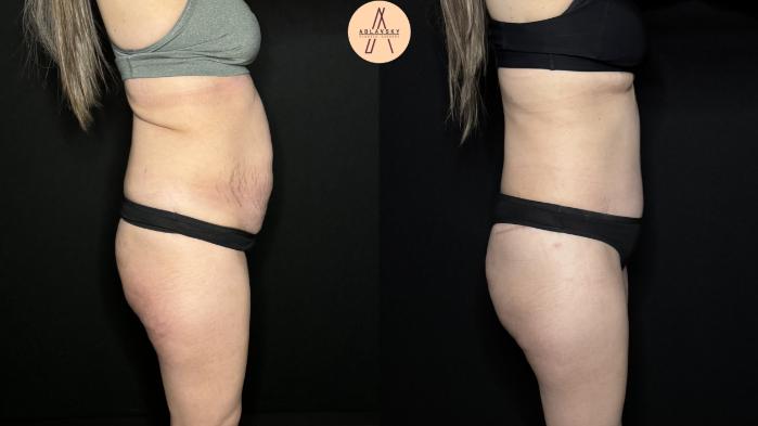 Before & After Tummy Tuck Case 327 Right Side View in San Antonio, Texas