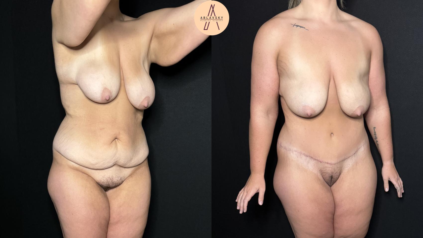 Before & After Tummy Tuck Case 330 Right Oblique View in San Antonio, Texas