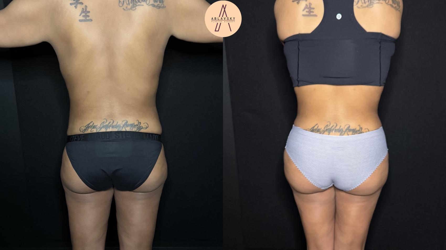 Before & After Liposuction Case 342 Back View in San Antonio, Texas