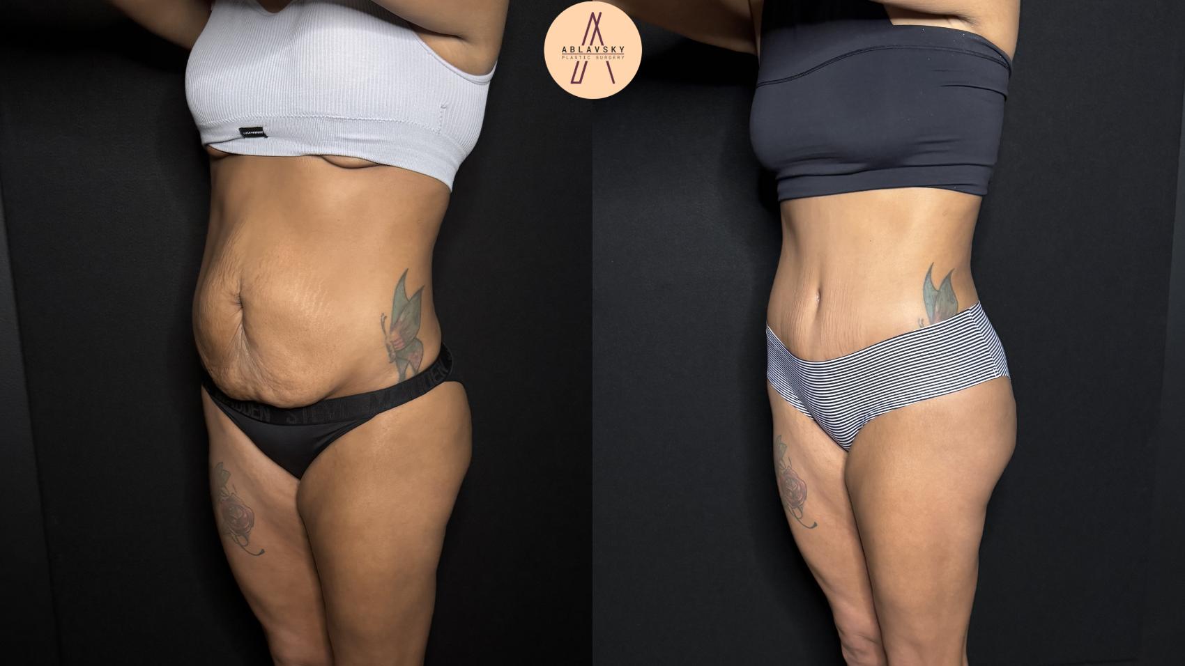 Before & After Liposuction Case 342 Left Oblique View in San Antonio, Texas