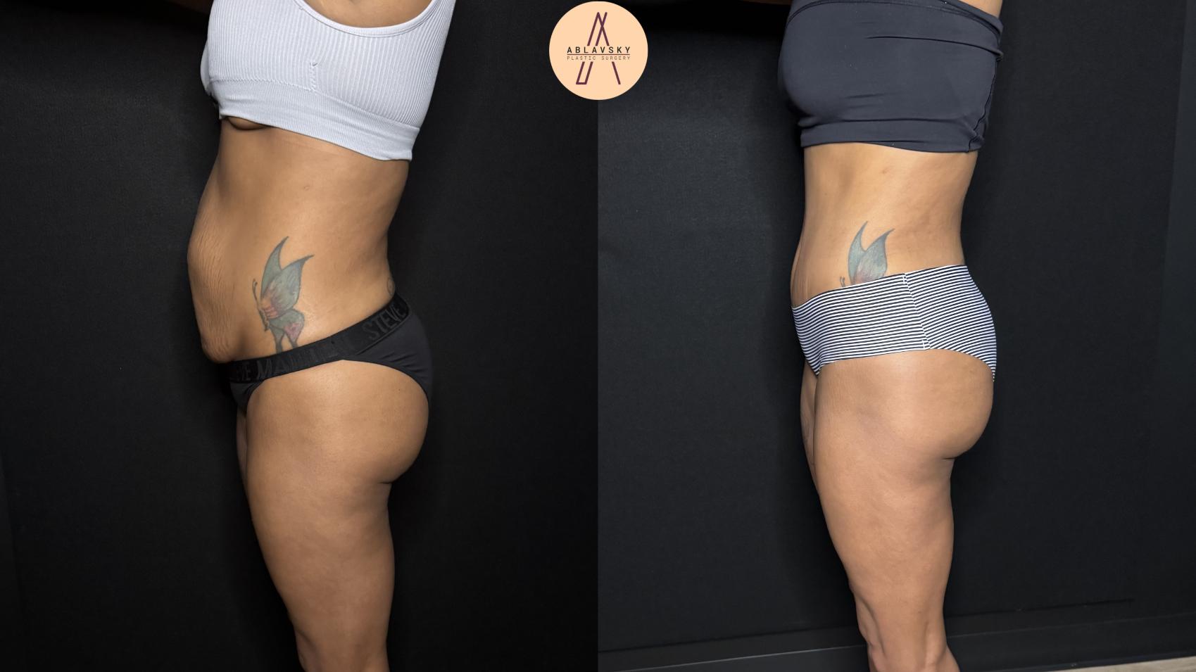 Before & After Liposuction Case 342 Left Side View in San Antonio, Texas