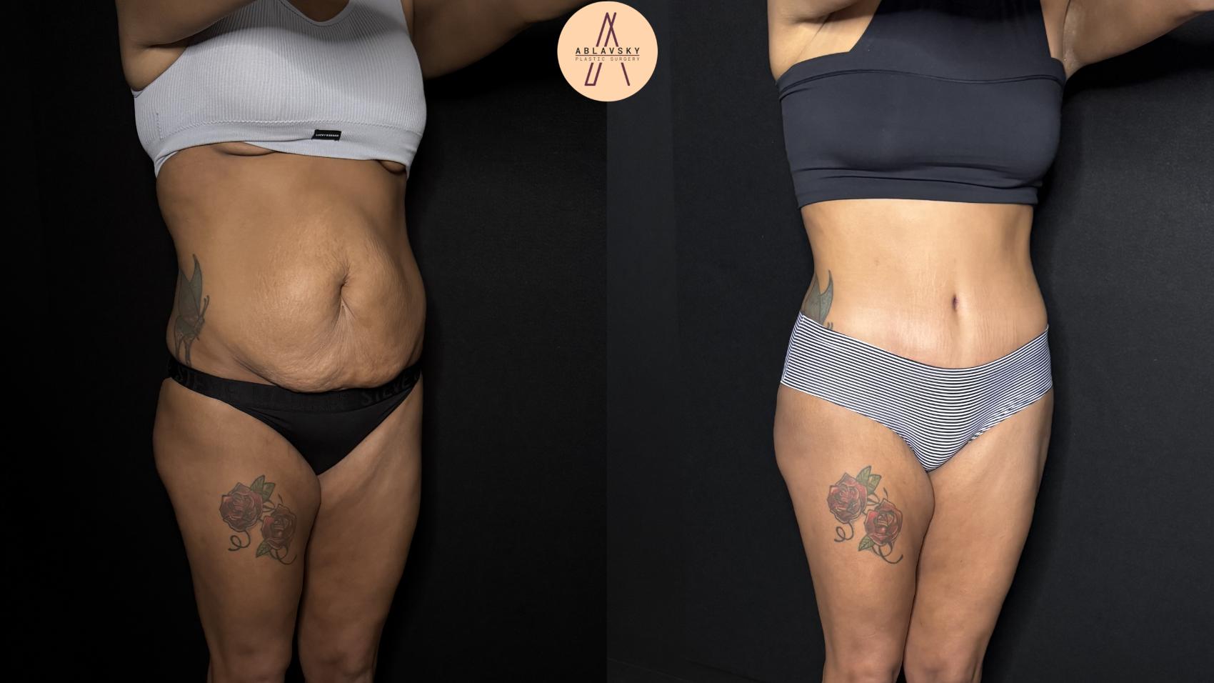 Before & After Liposuction Case 342 Right Oblique View in San Antonio, Texas