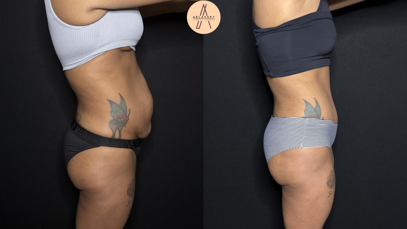 Before & After Liposuction Case 342 Right Side View in San Antonio, Texas