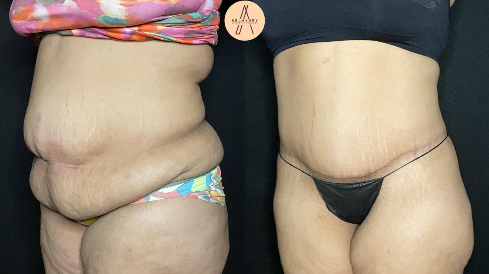 Before & After Tummy Tuck Case 345 Left Oblique View in San Antonio, Texas