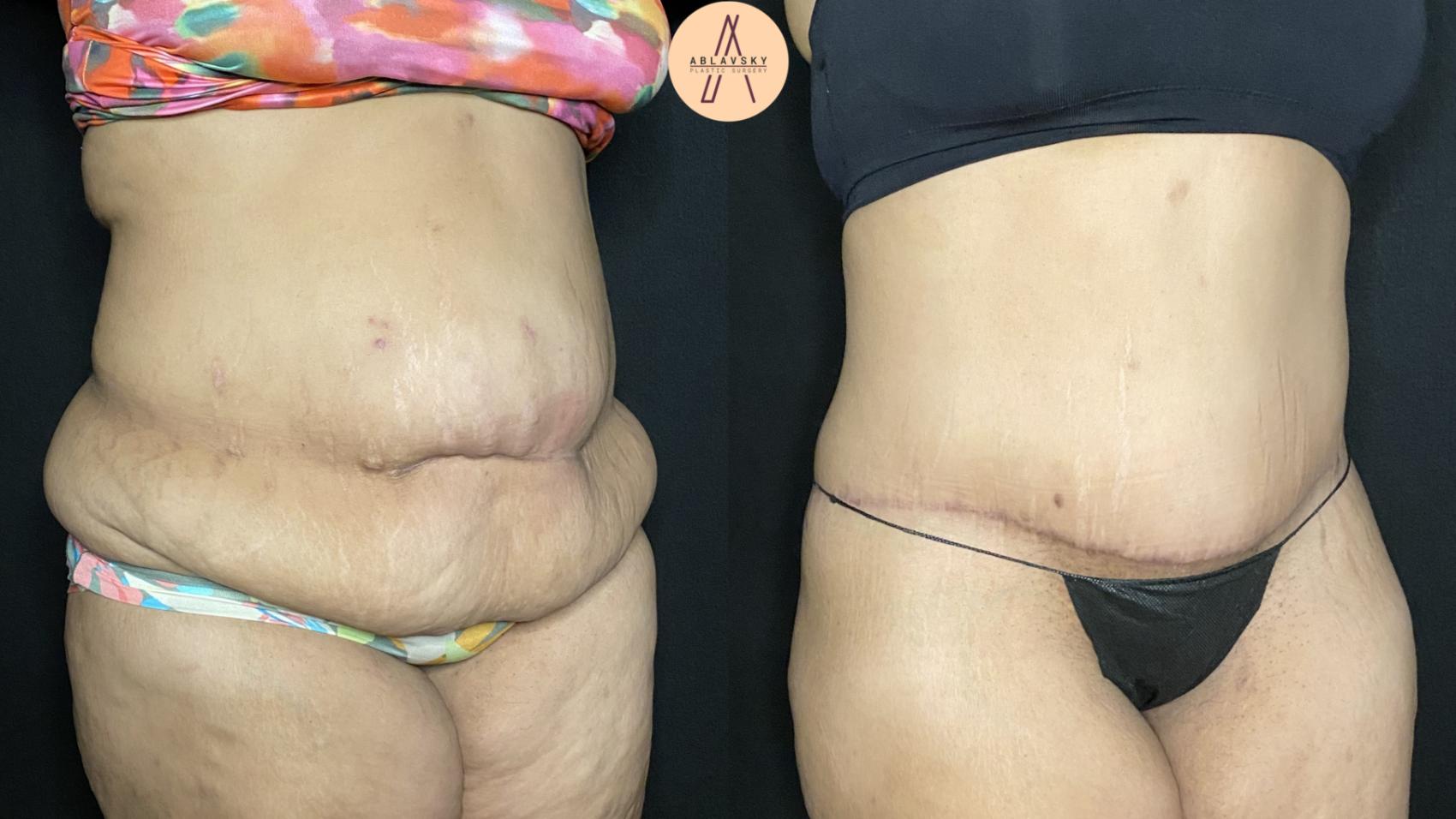 Before & After Tummy Tuck Case 345 Right Oblique View in San Antonio, Texas