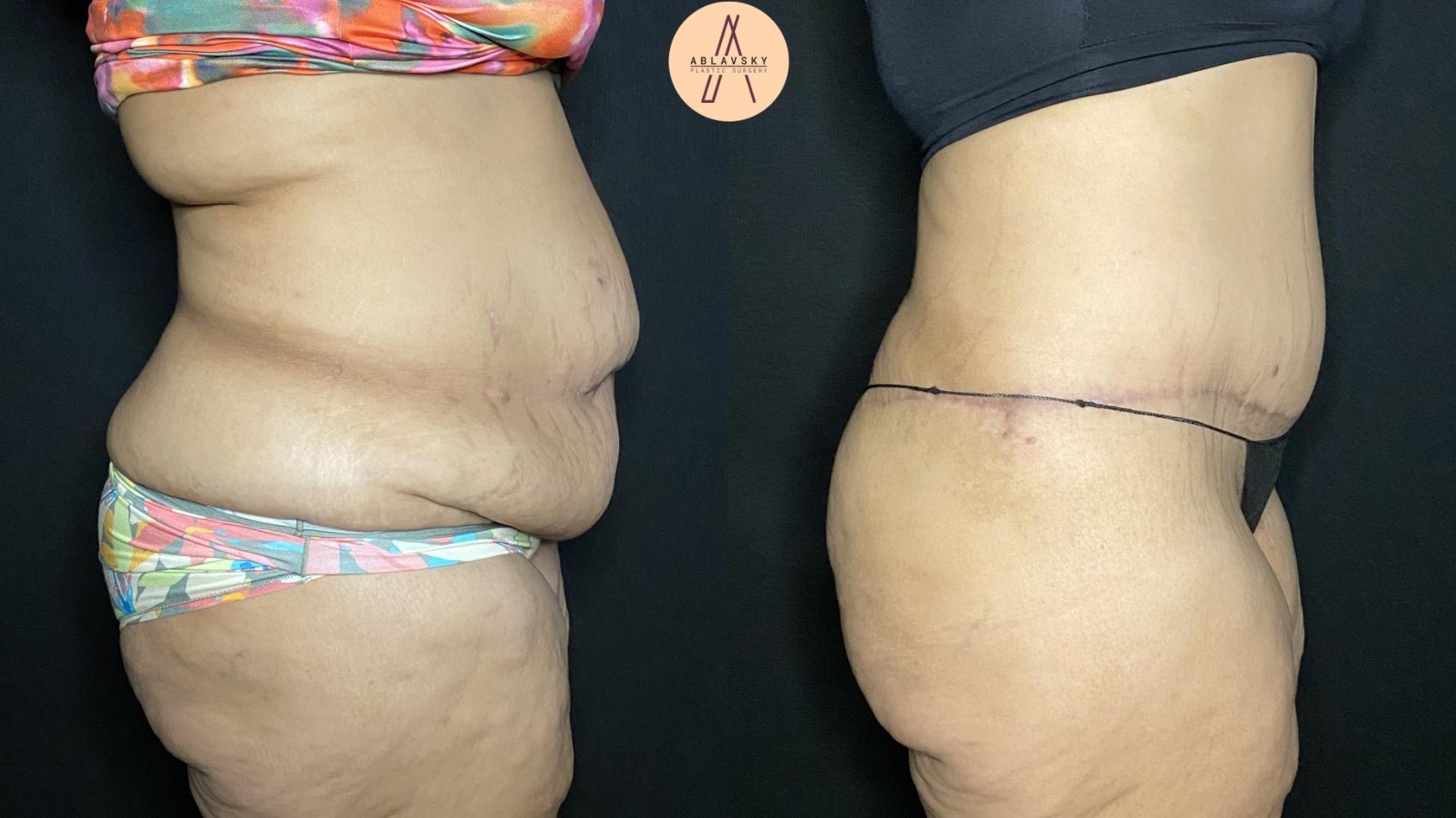 Before & After Tummy Tuck Case 345 Right Side View in San Antonio, Texas