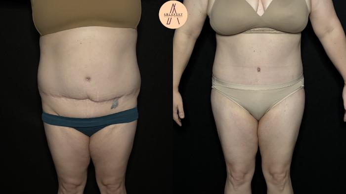 Before & After Tummy Tuck Case 355 Front View in San Antonio, Texas