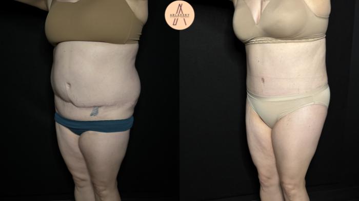 Before & After Tummy Tuck Case 355 Left Oblique View in San Antonio, Texas