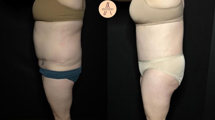Before & After Tummy Tuck Case 355 Left Side View in San Antonio, Texas