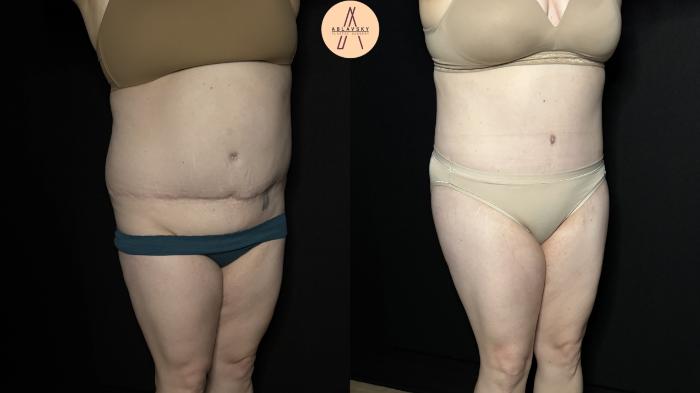 Before & After Tummy Tuck Case 355 Right Oblique View in San Antonio, Texas
