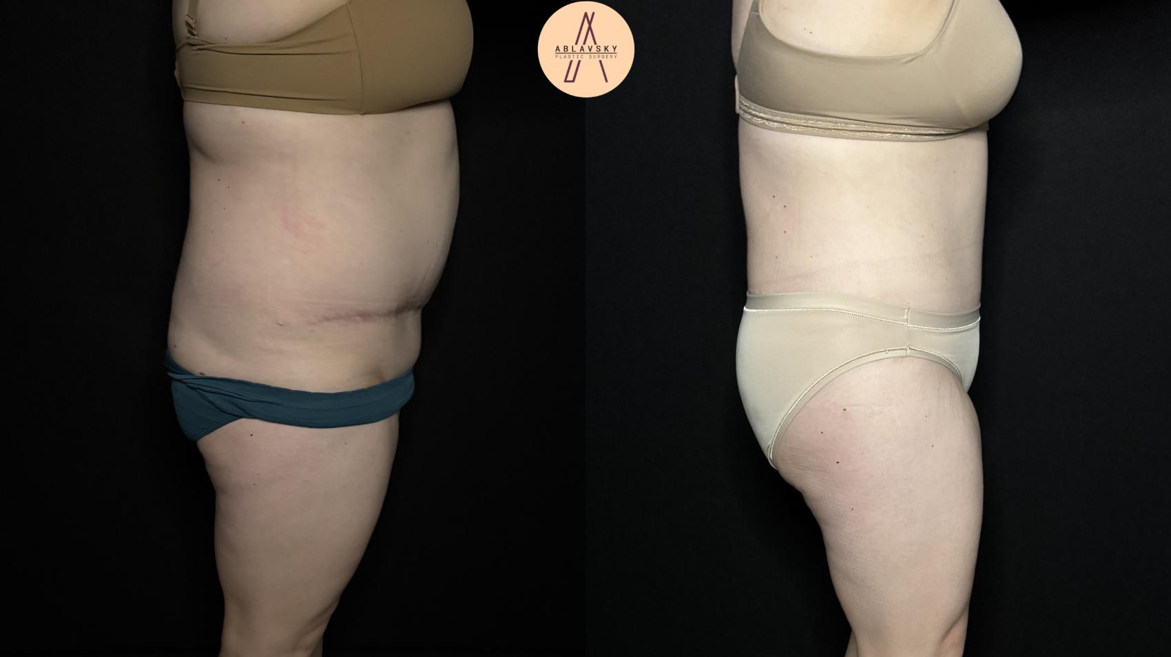 Before & After Tummy Tuck Case 355 Right Side View in San Antonio, Texas