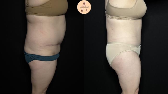 Before & After Tummy Tuck Case 355 Right Side View in San Antonio, Texas