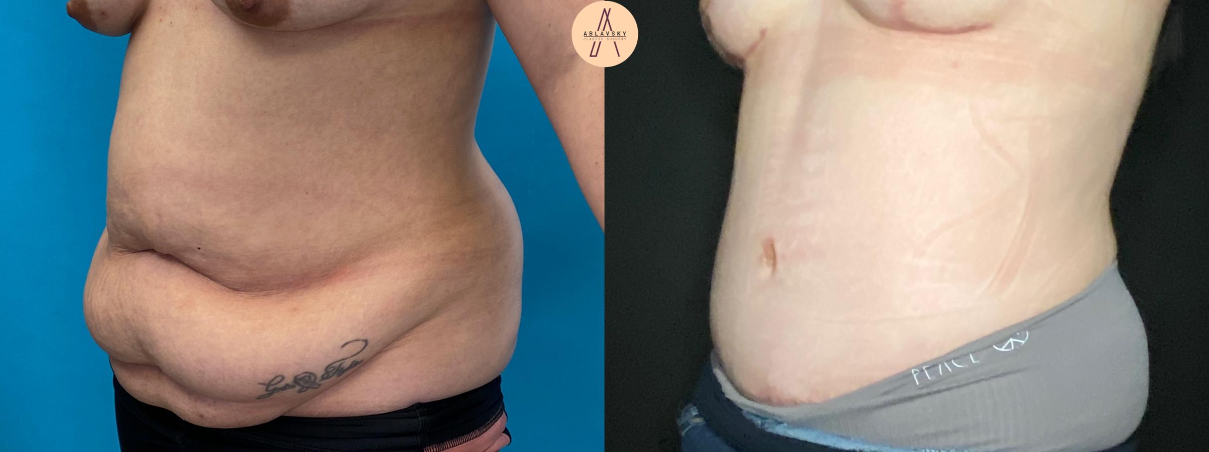 Before & After Tummy Tuck Case 36 Left Oblique View in San Antonio, Texas