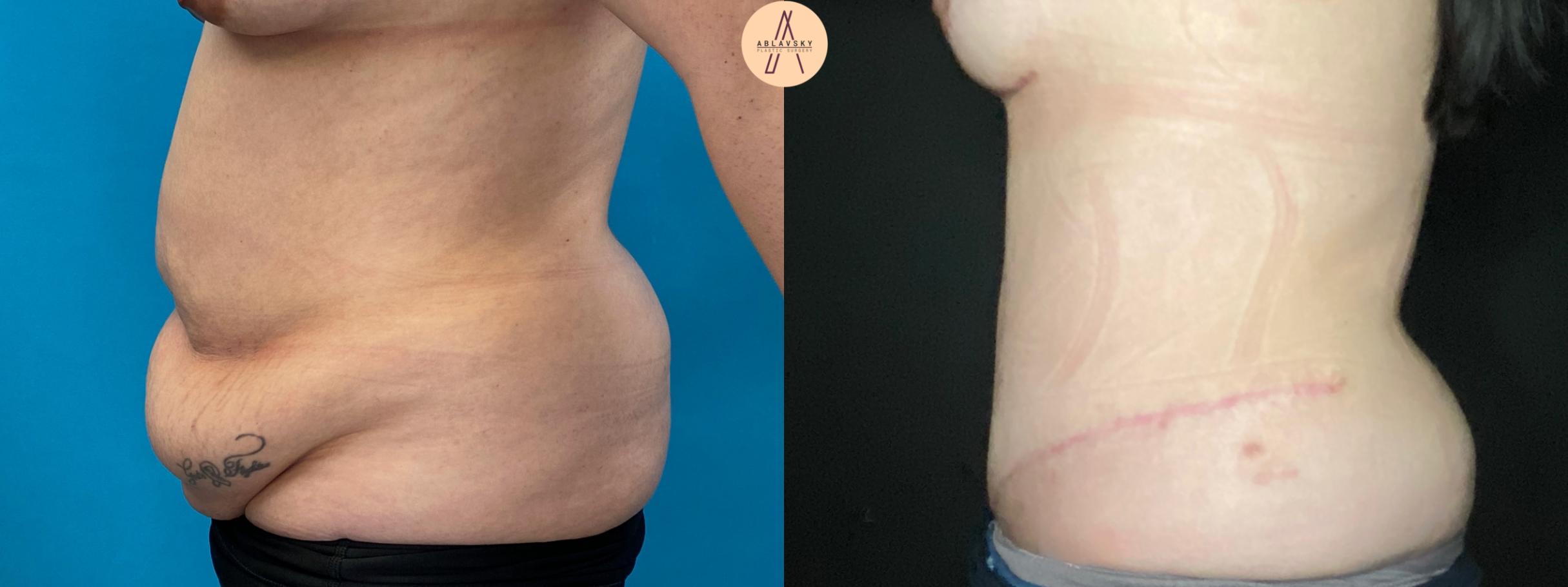 Before & After Tummy Tuck Case 36 Left Side View in San Antonio, Texas