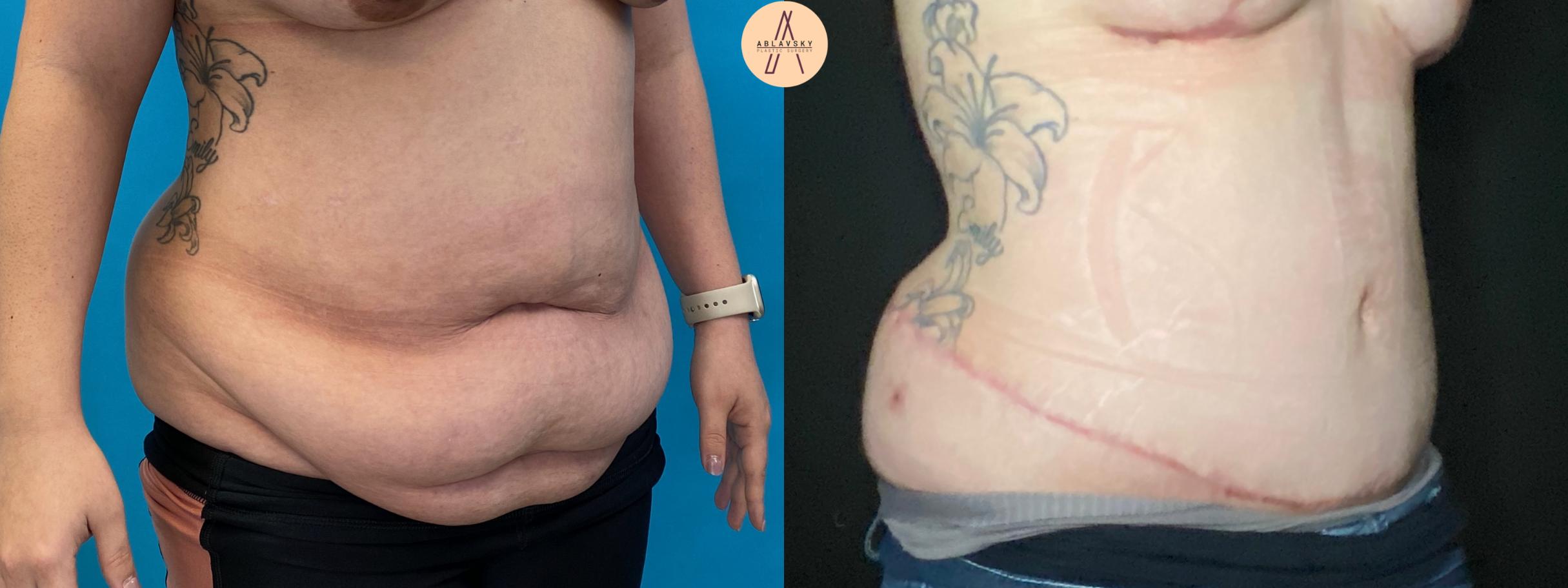 Before & After Tummy Tuck Case 36 Right Oblique View in San Antonio, Texas