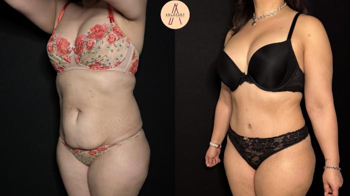 Before & After Liposuction Case 369 Left Oblique View in San Antonio, Texas