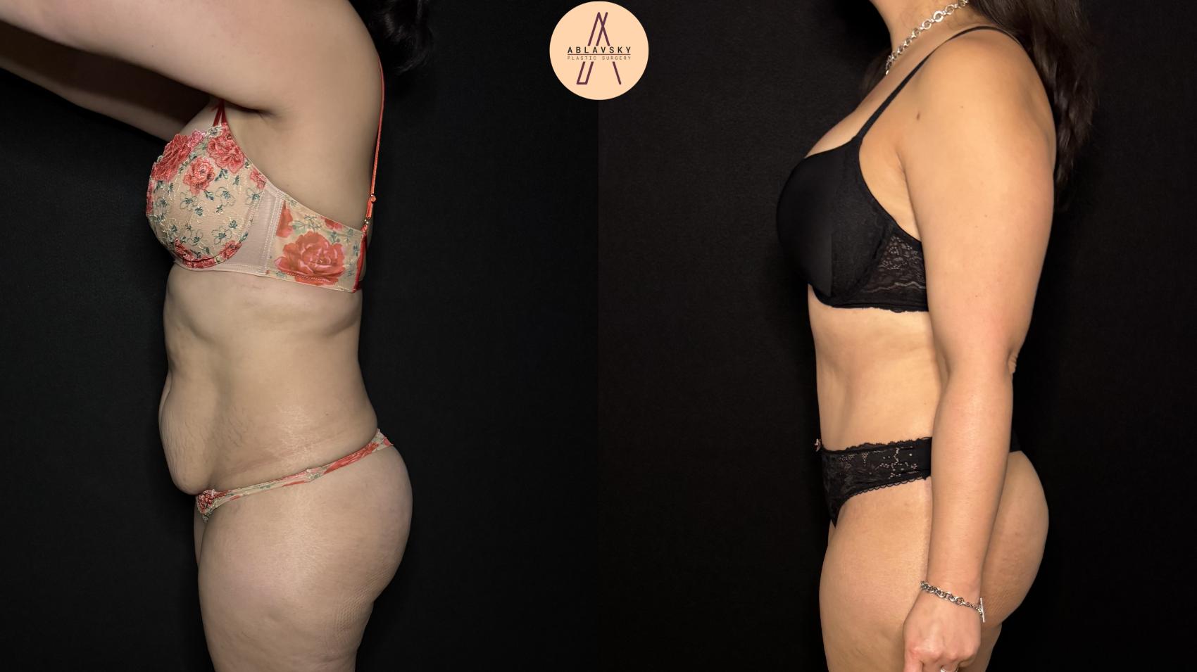 Before & After Tummy Tuck Case 369 Left Side View in San Antonio, Texas