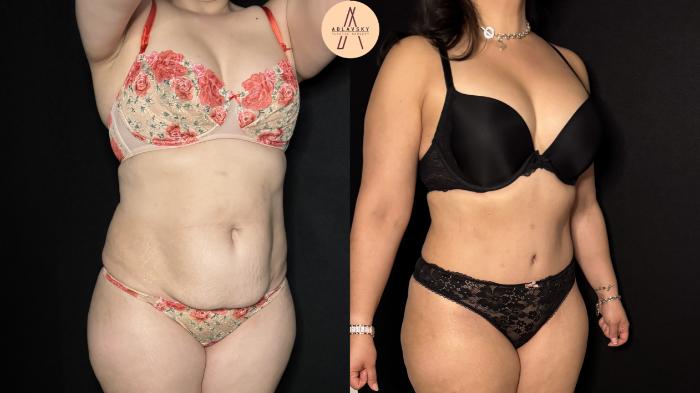 Before & After Liposuction Case 369 Right Oblique View in San Antonio, Texas