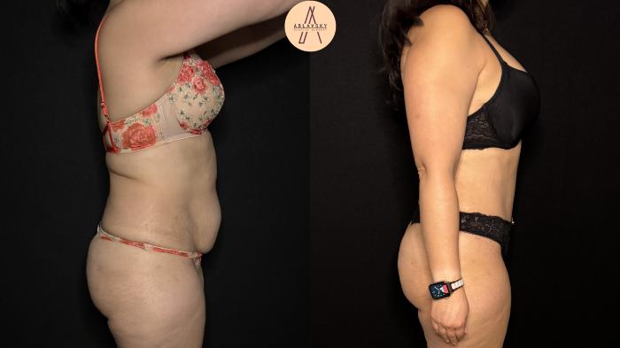 Before & After Liposuction Case 369 Right Side View in San Antonio, Texas