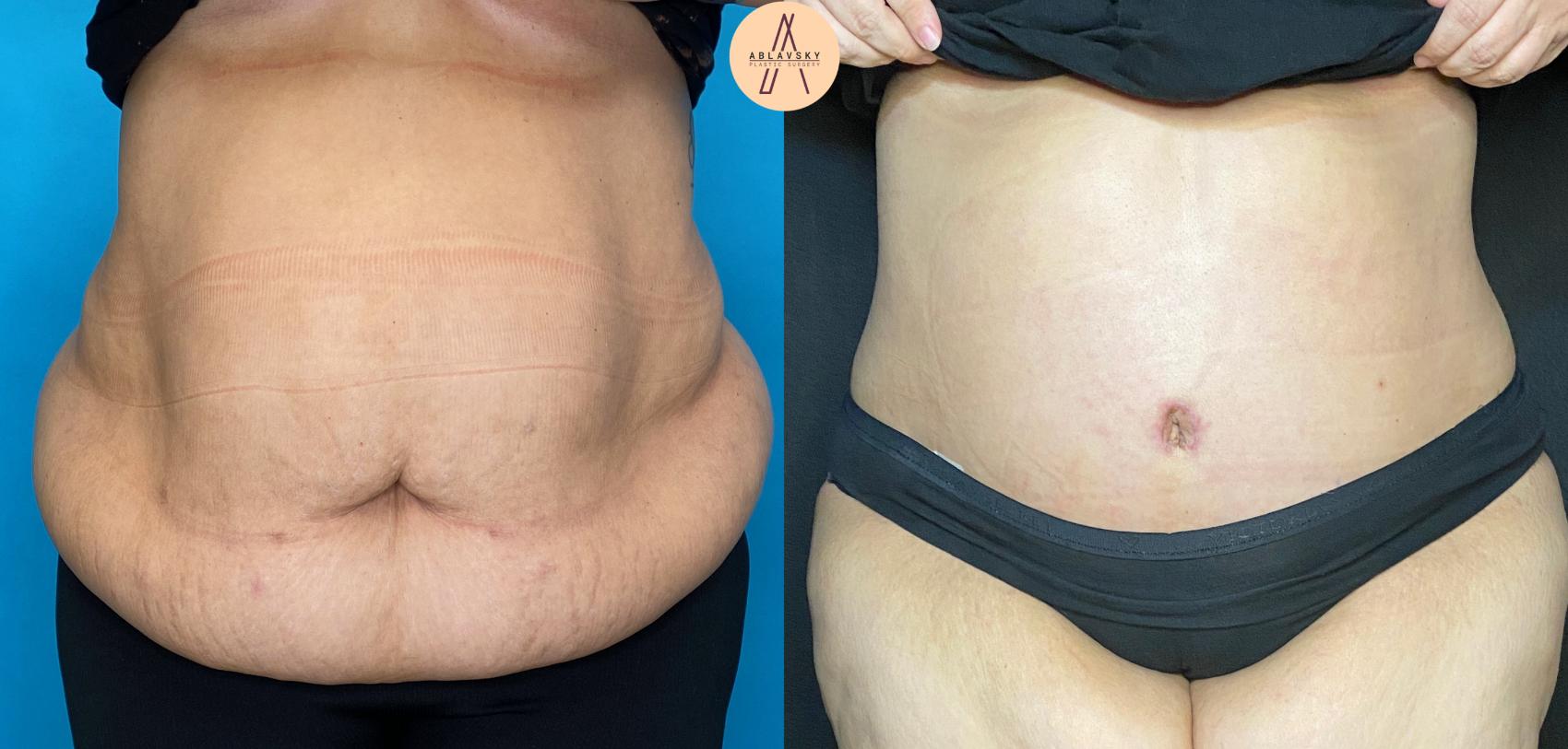 Before & After Tummy Tuck Case 37 Front View in San Antonio, Texas