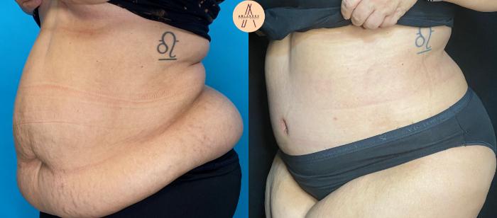 Before & After Tummy Tuck Case 37 Left Oblique View in San Antonio, Texas